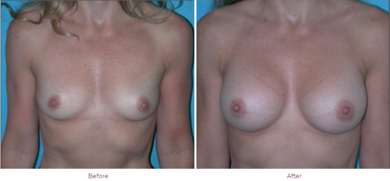 Breast Augmentation Boca Raton, FL
