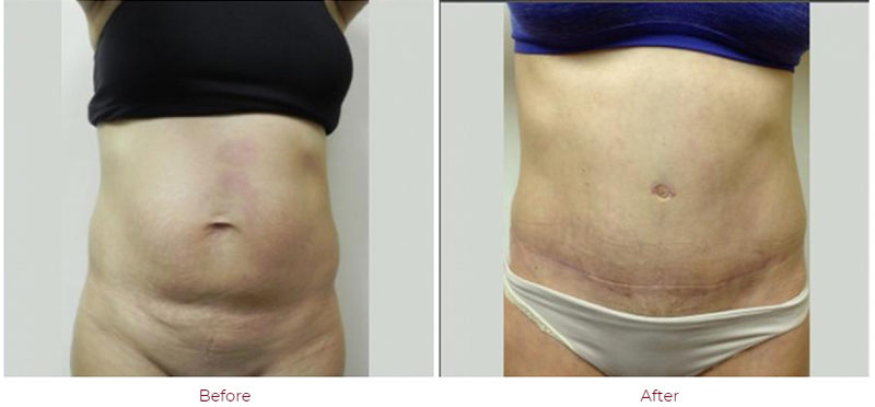 Image | Abdominoplasty | Before & After