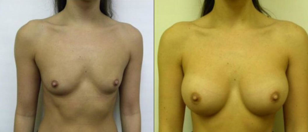 Breast Augmentation Boca Raton