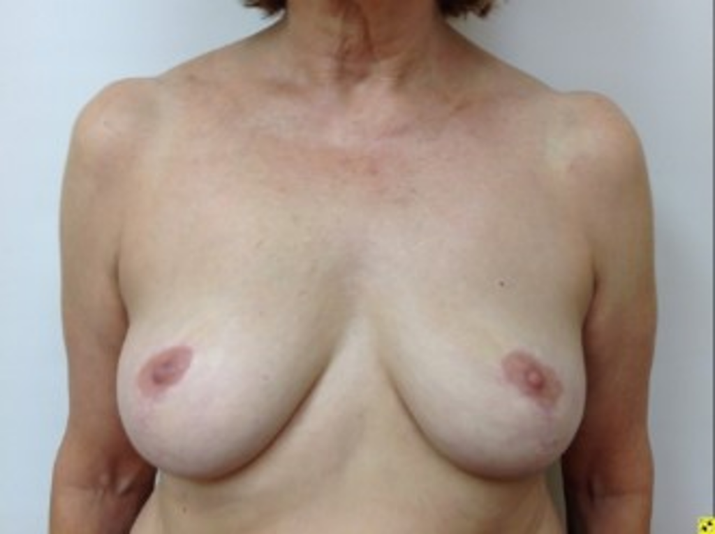 breast-liposuction-after-1
