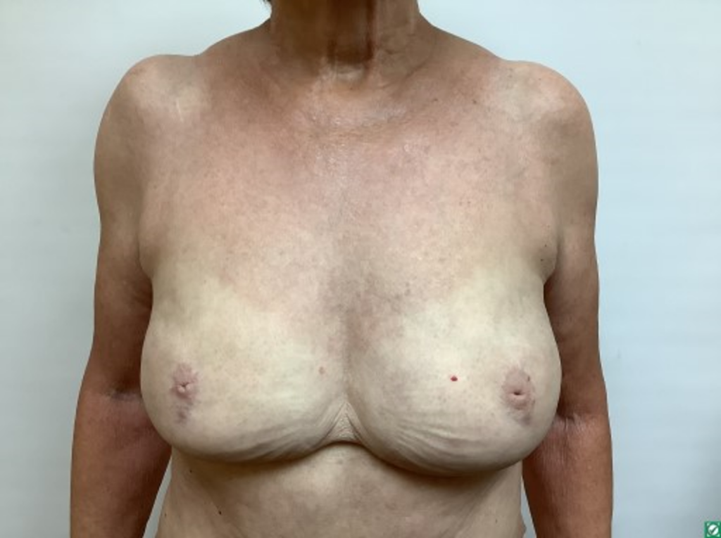 breast-liposuction-after-2-1