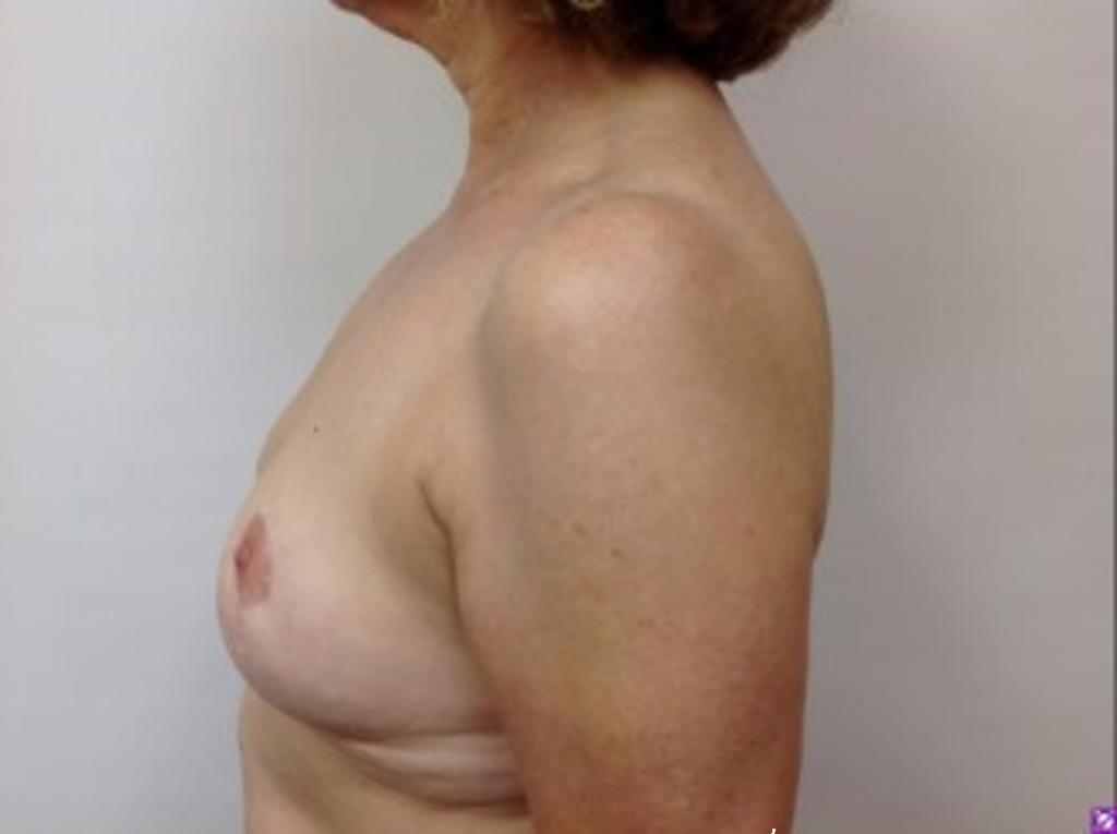 breast-liposuction-after-2