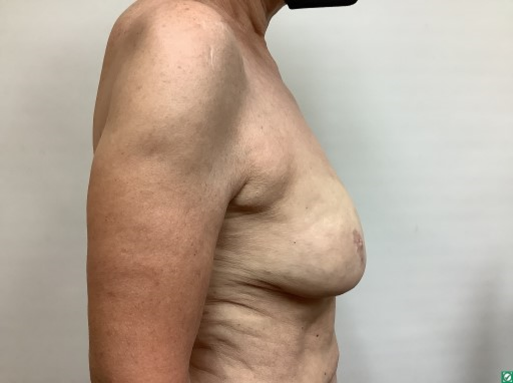 breast-liposuction-after-2-2