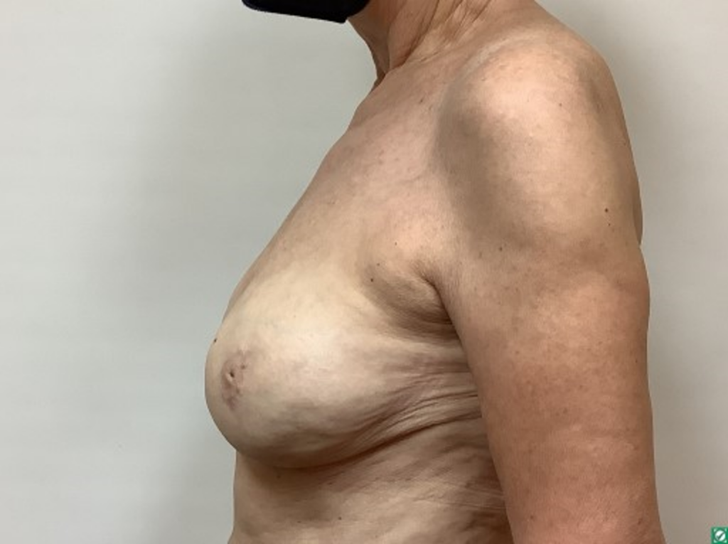 breast-liposuction-after-2-3