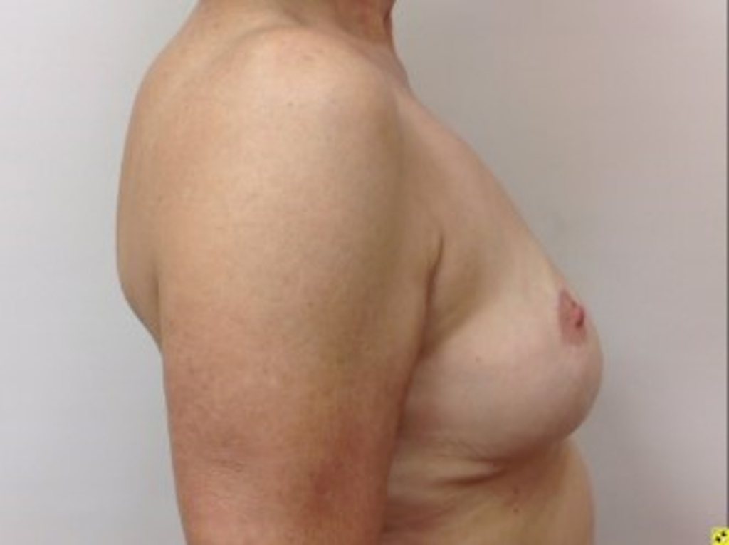 breast-liposuction-after-3