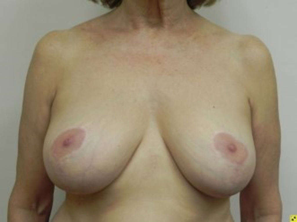 breast-liposuction-before-1