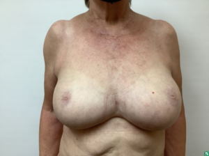 breast-liposuction-before-2-1