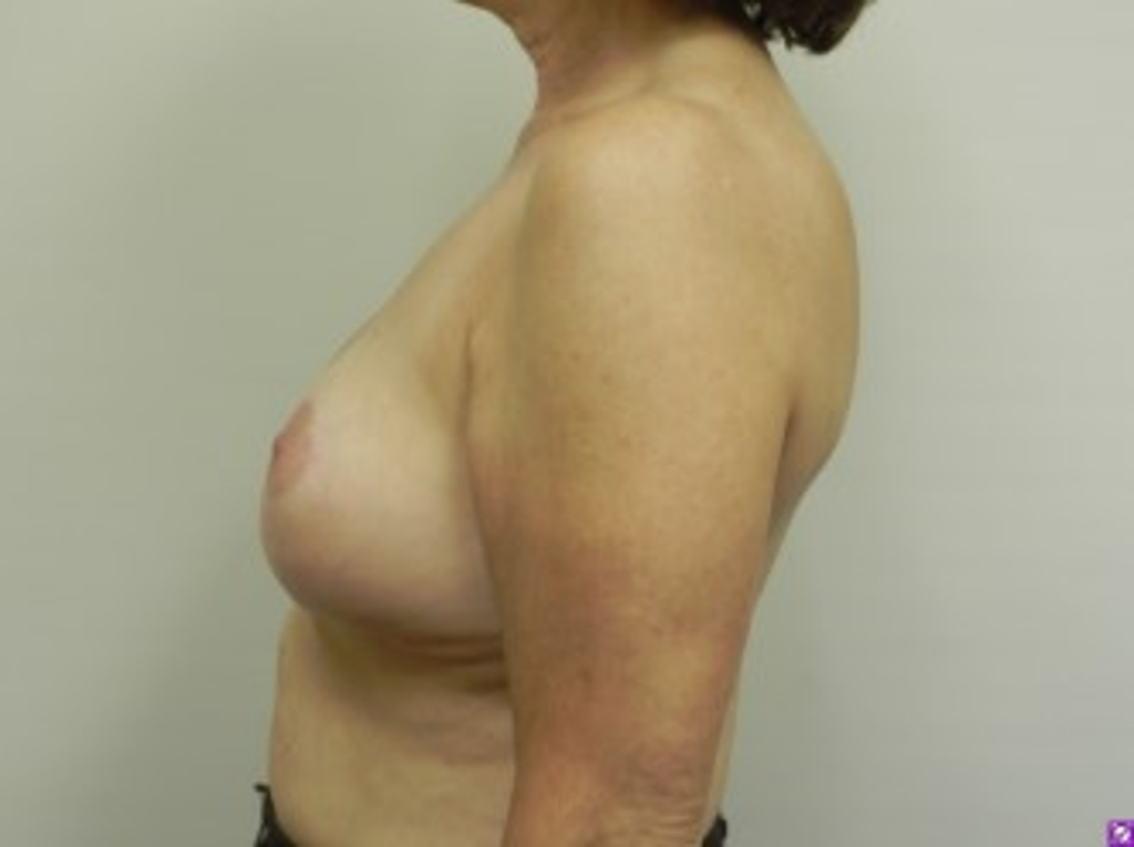 breast-liposuction-before-2