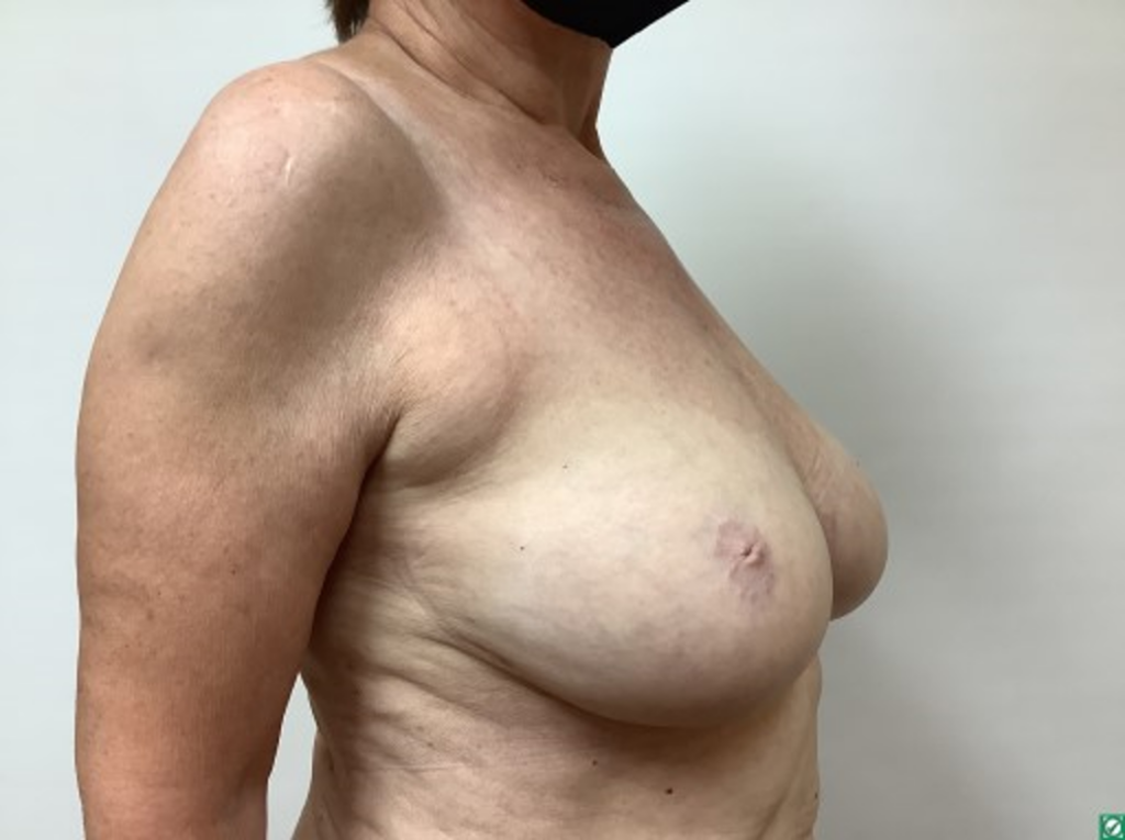 breast-liposuction-before-2-2