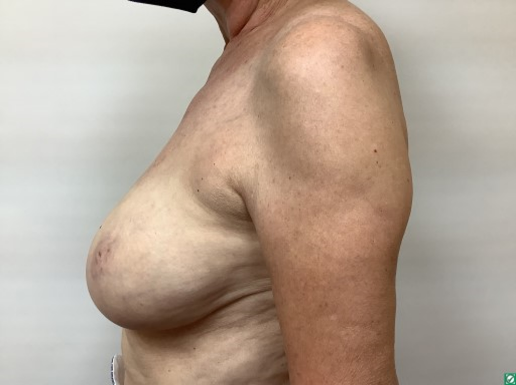 breast-liposuction-before-2-3