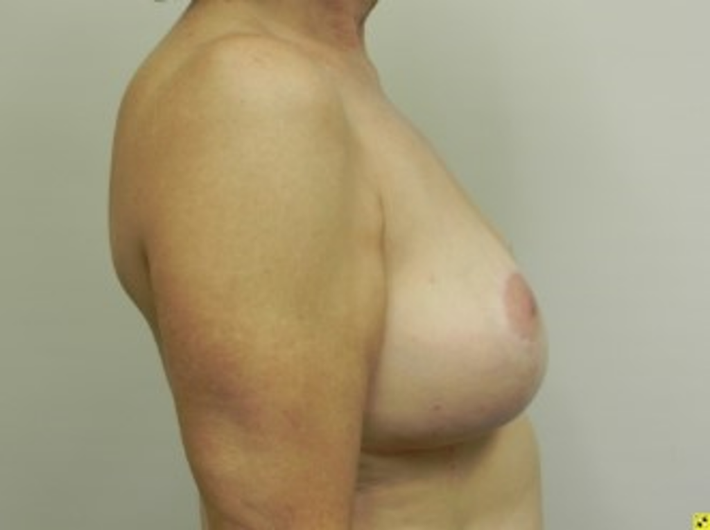 breast-liposuction-before-3