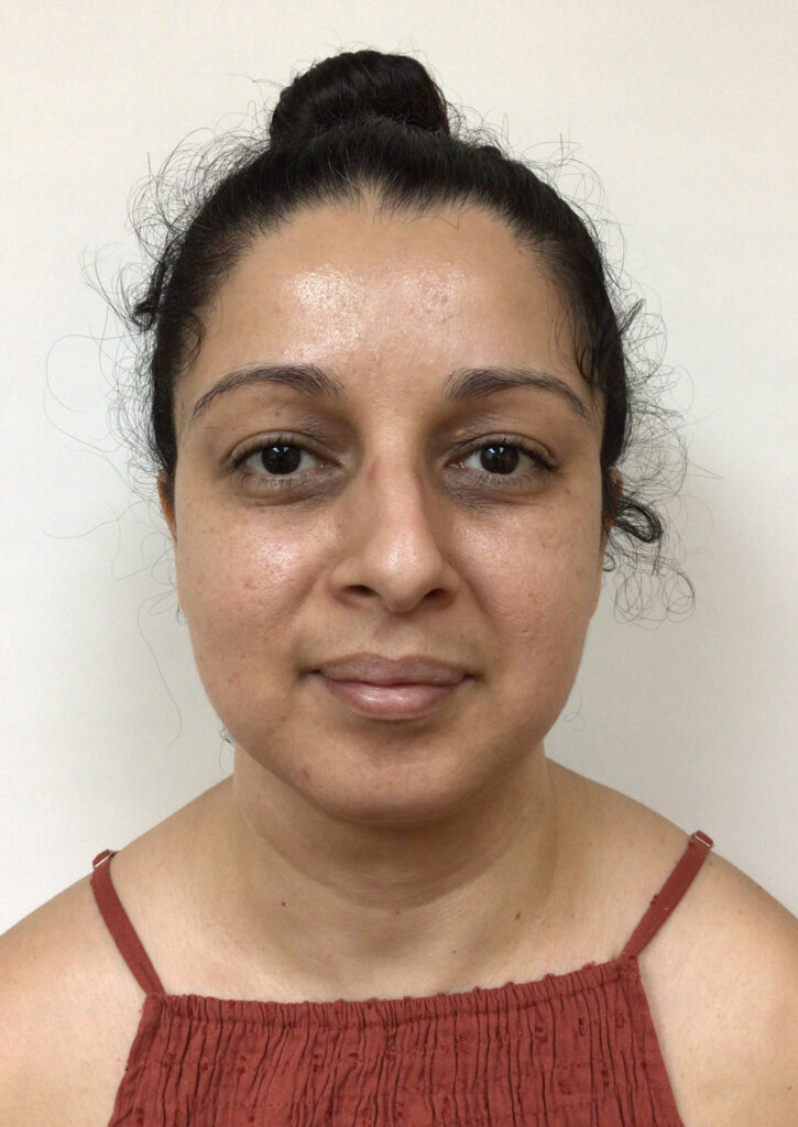 Chin & Neck Liposuction - After Picture - Front View