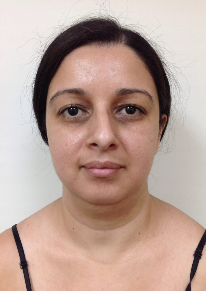 Chin & Neck Liposuction - Before Picture - Front View