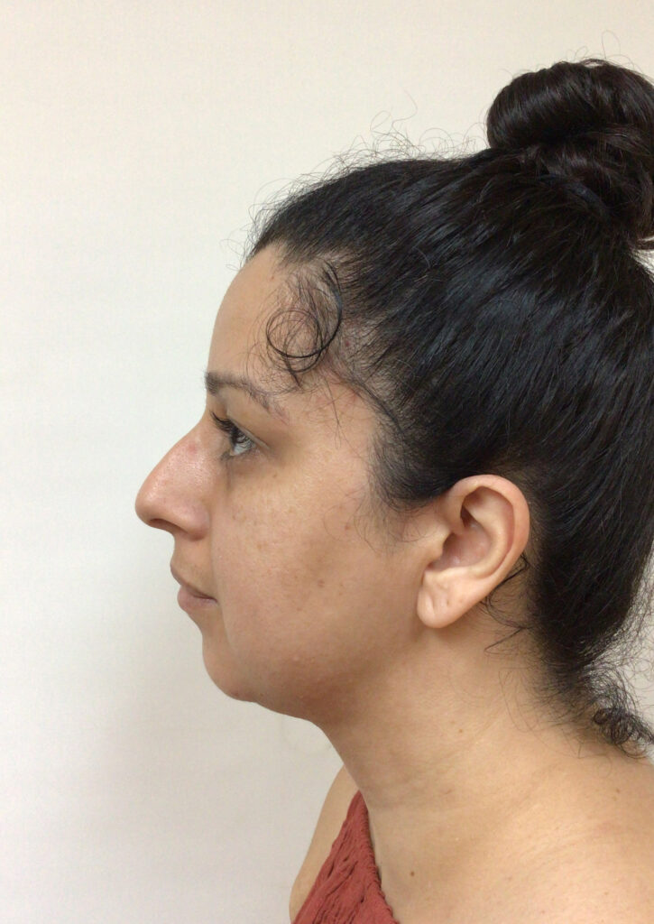 Chin & Neck Liposuction - After Picture - Side View