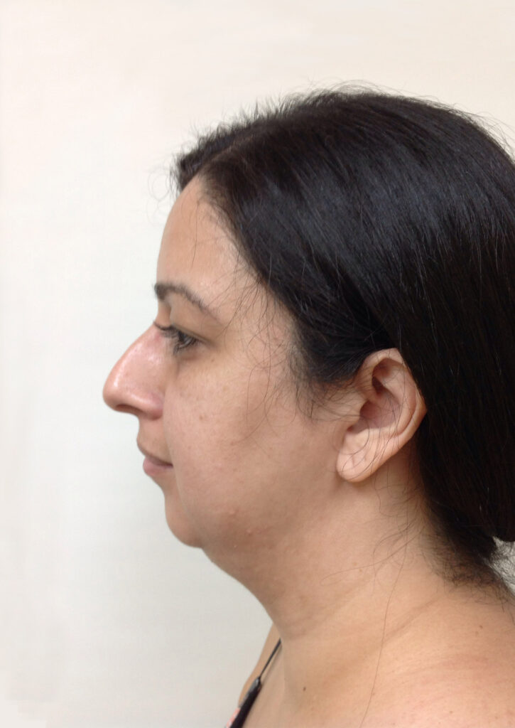Chin & Neck Liposuction - Before Picture - Side View