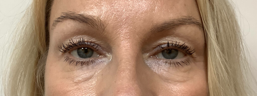 eyelid-before-3-1
