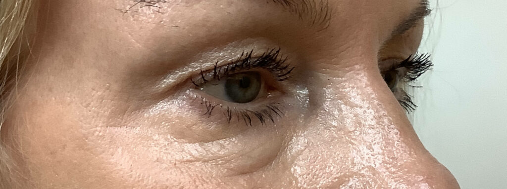 eyelid-before-3-2
