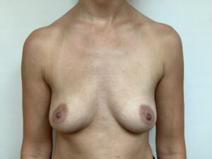 female age 34 Before breast augment silicone 1