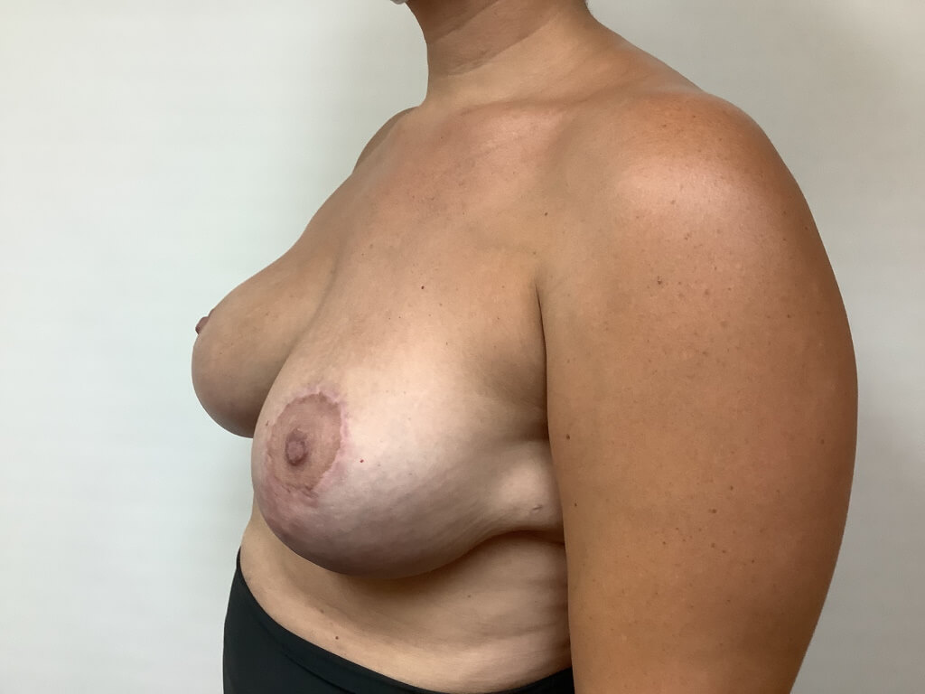 Breast Reduction Female Age 34 after3