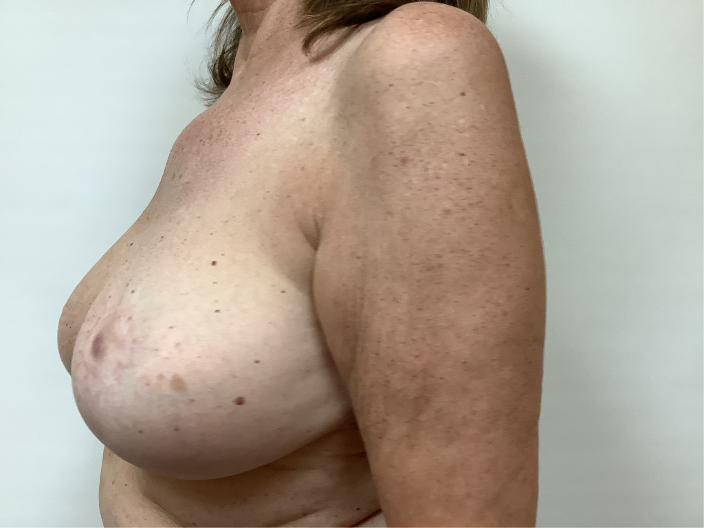 breast-reduction-after-61-2