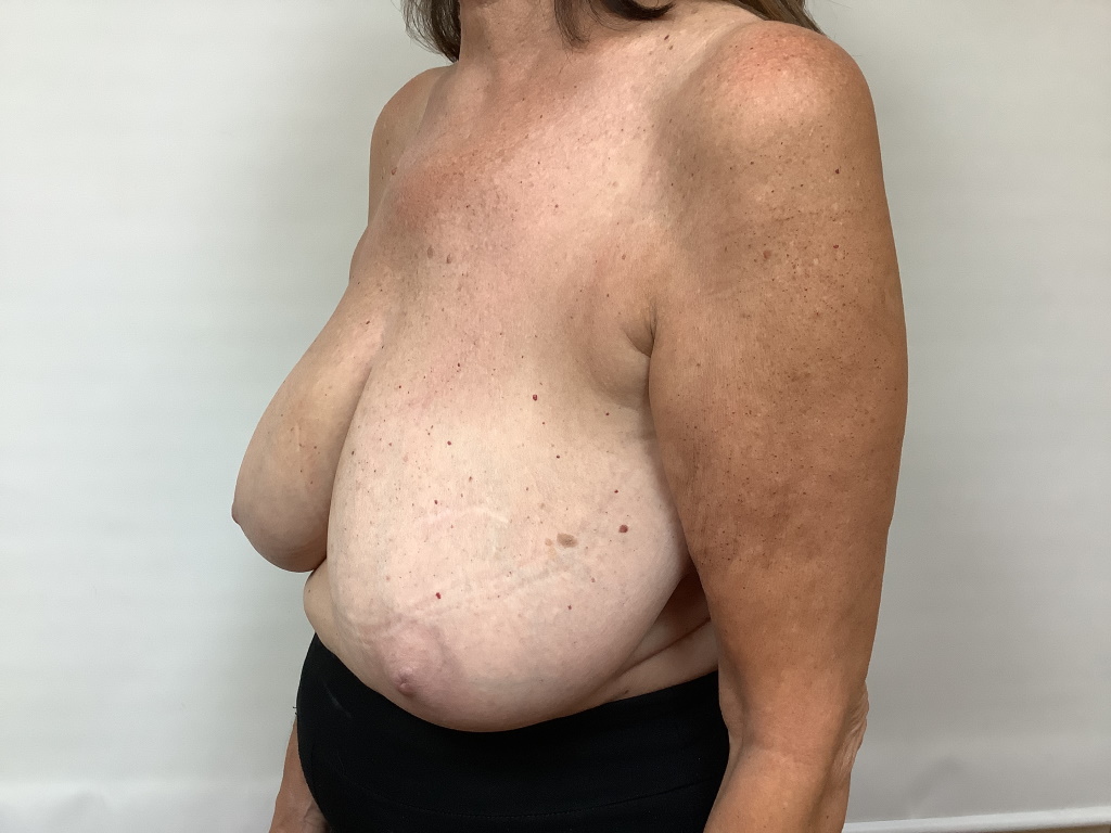 breast-reduction-before-61-2