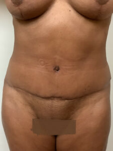 abdominoplasty-before-4
