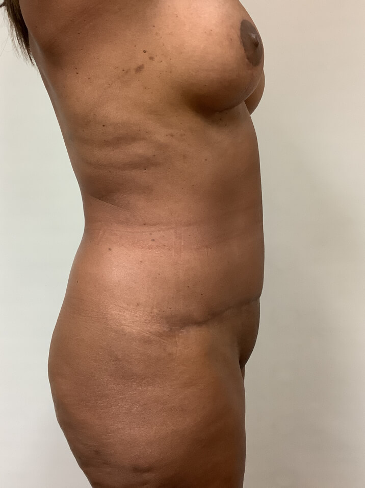 abdominoplasty-before-5