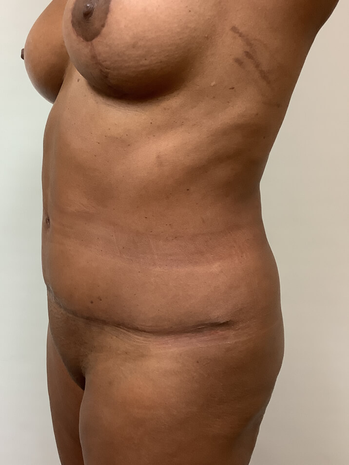 abdominoplasty-before-6