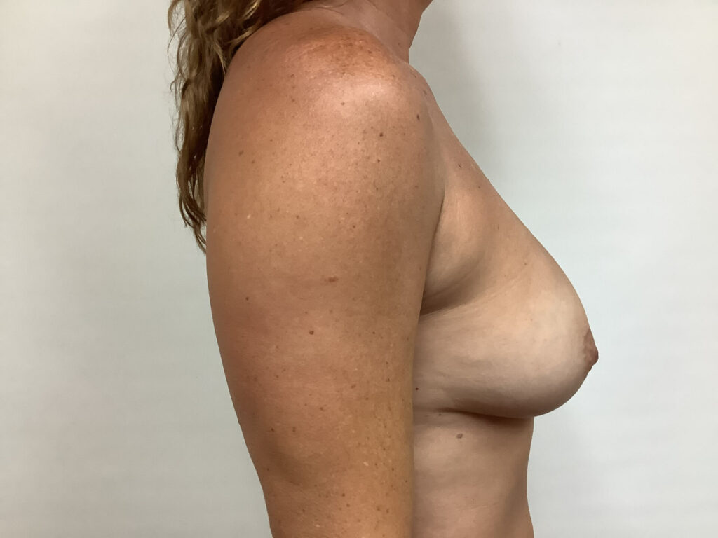 breast-reaugmentation-2-3