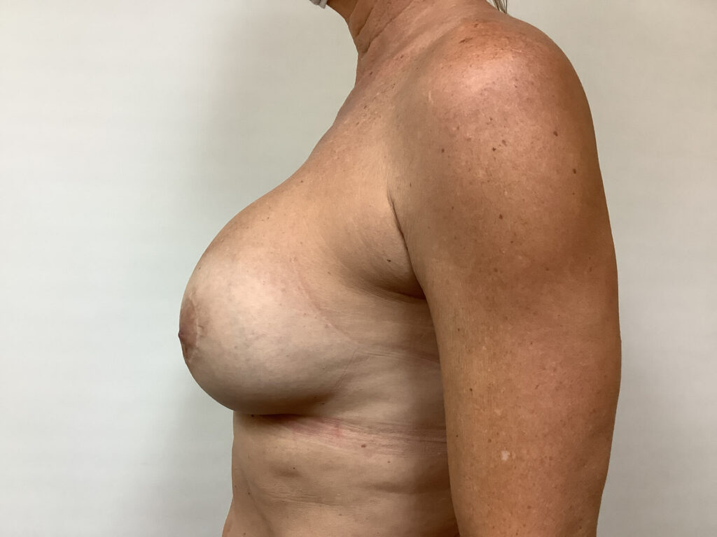 breast-reaugmentation-2-5