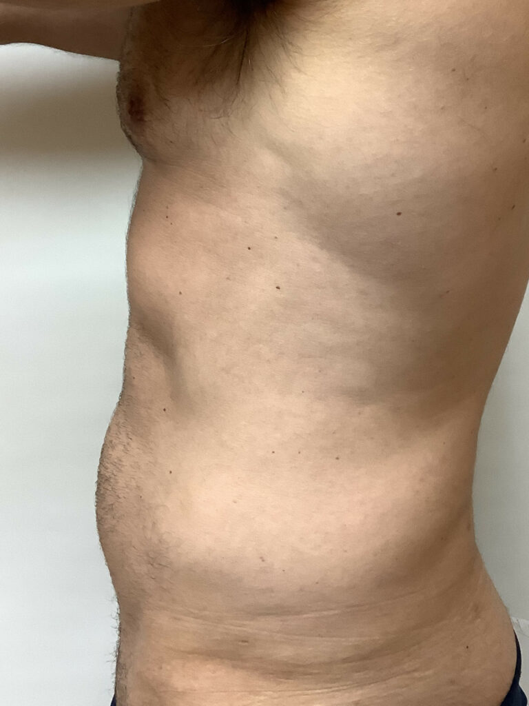 liposuction-1-4