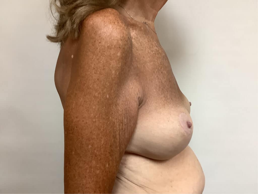 breast-asymmetry-64-after-2