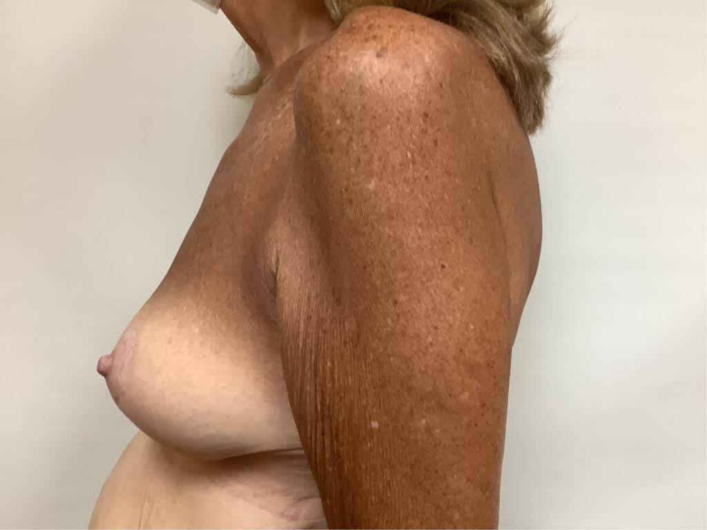 breast-asymmetry-64-after-3