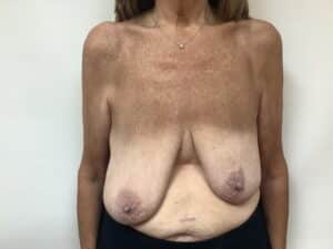 breast-asymmetry-64-before-3