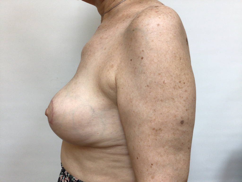 68 Female Breast Reduction AFTER 2