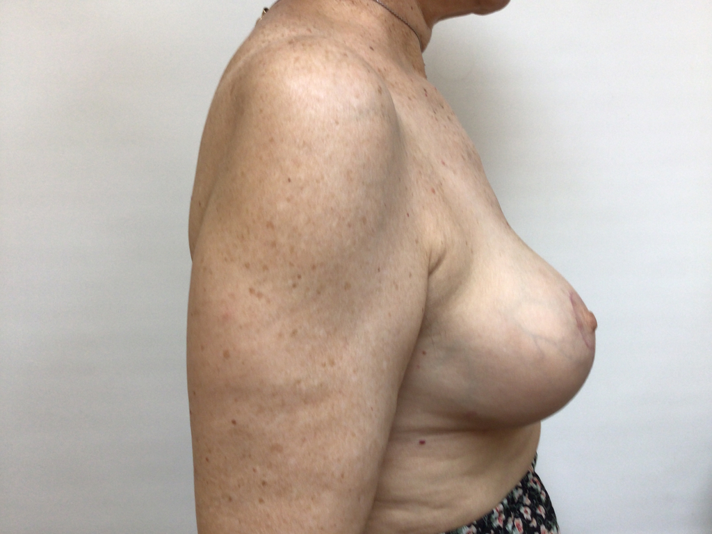 68 Female Breast Reduction AFTER 3