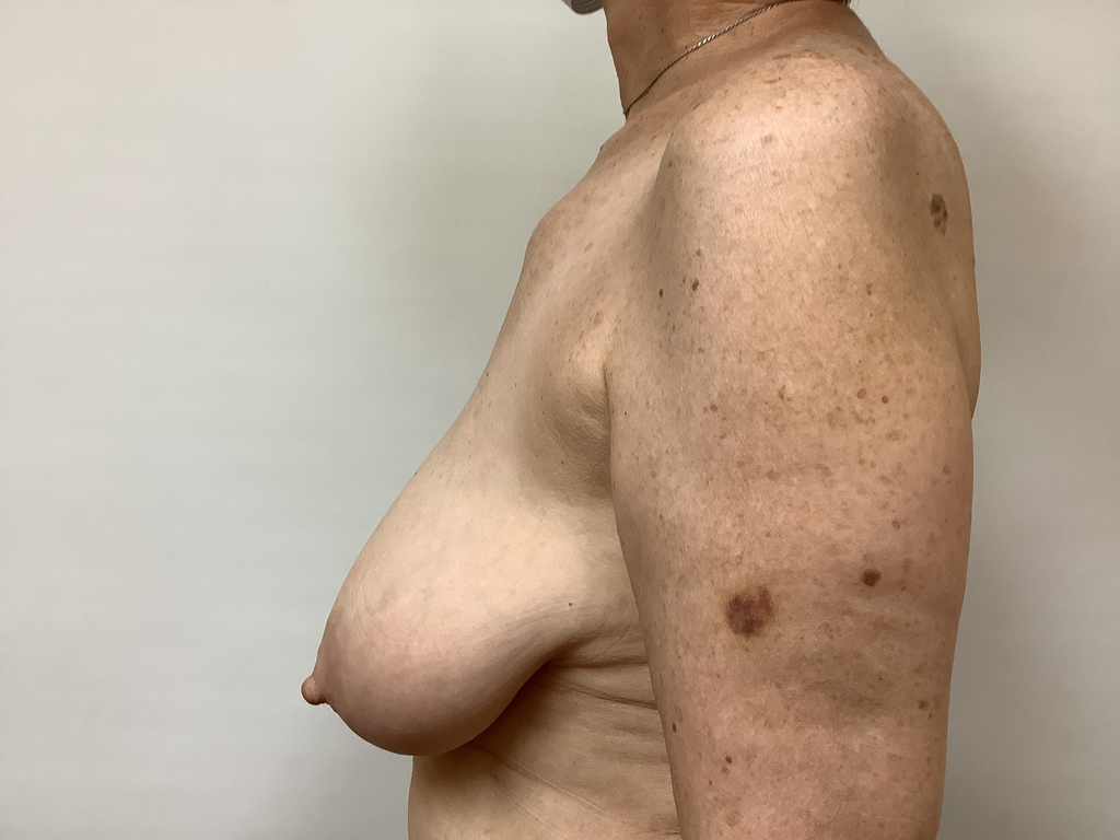 68 Female Breast Reduction BEFORE 3