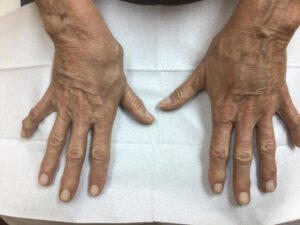 https://www.drkeusch.com/wp-content/uploads/2023/06/72-YO-female-hands-after-filler-injections-.jpg