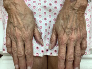 72 YO female hands, before filler injections