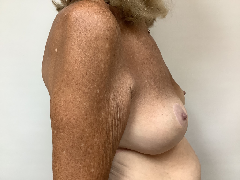 AFTER age 64 female breast asymmetry 1