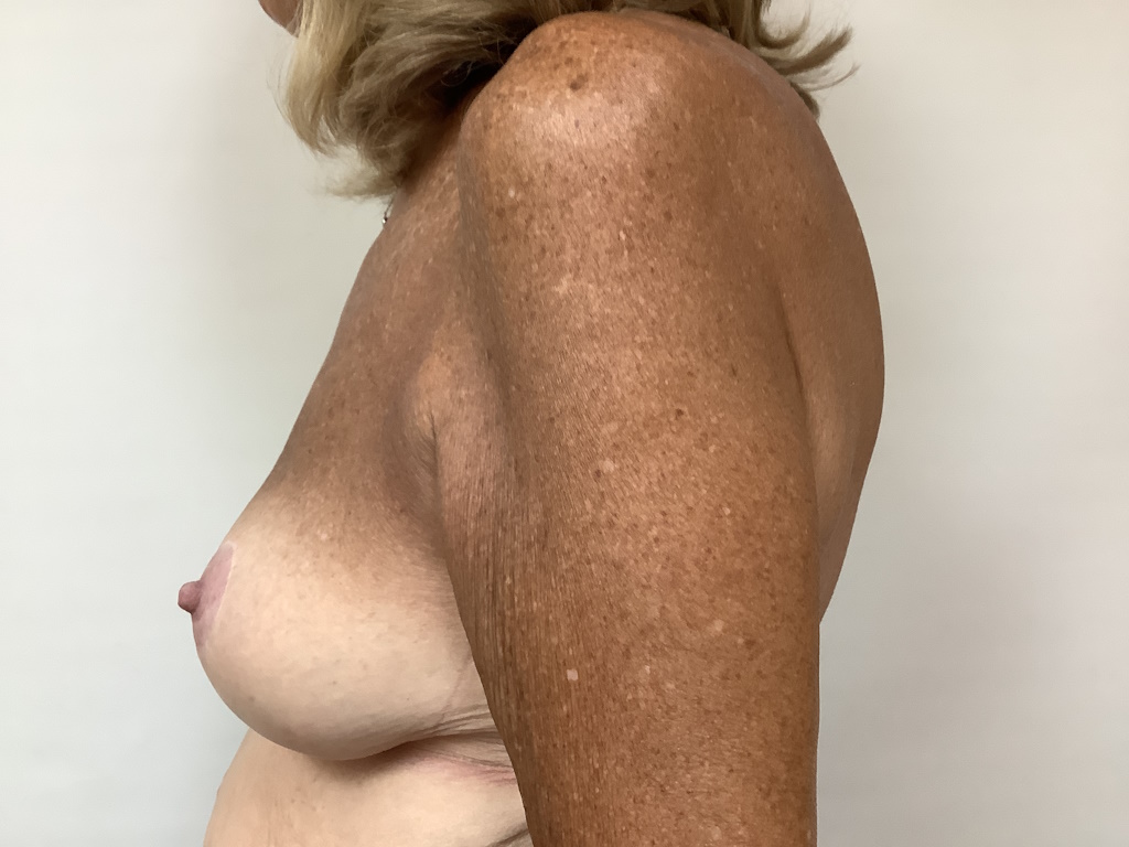 AFTER age 64 female breast asymmetry 2