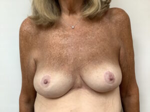 AFTER age 64 female breast asymmetry 3