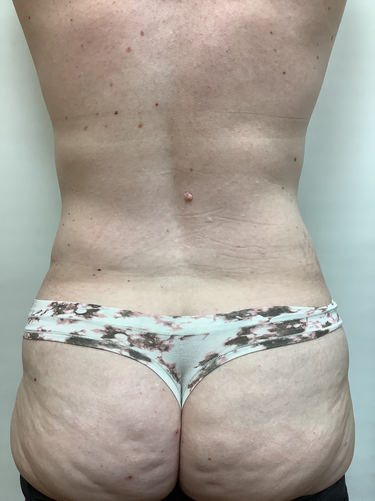 AFTER smart lipo female age 41