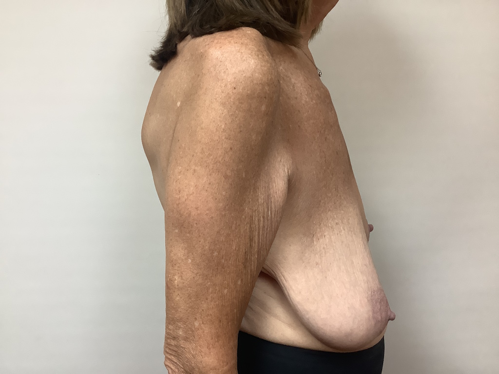 BEFORE age 64 breast asymmetry1