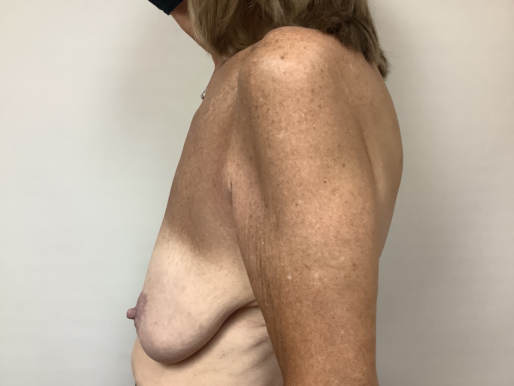 BEFORE age 64 breast asymmetry2