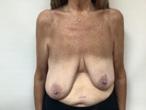 BEFORE age 64 breast asymmetry3