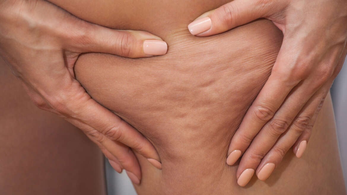 Cellulite Removal with Avéli: What You Need to Know
