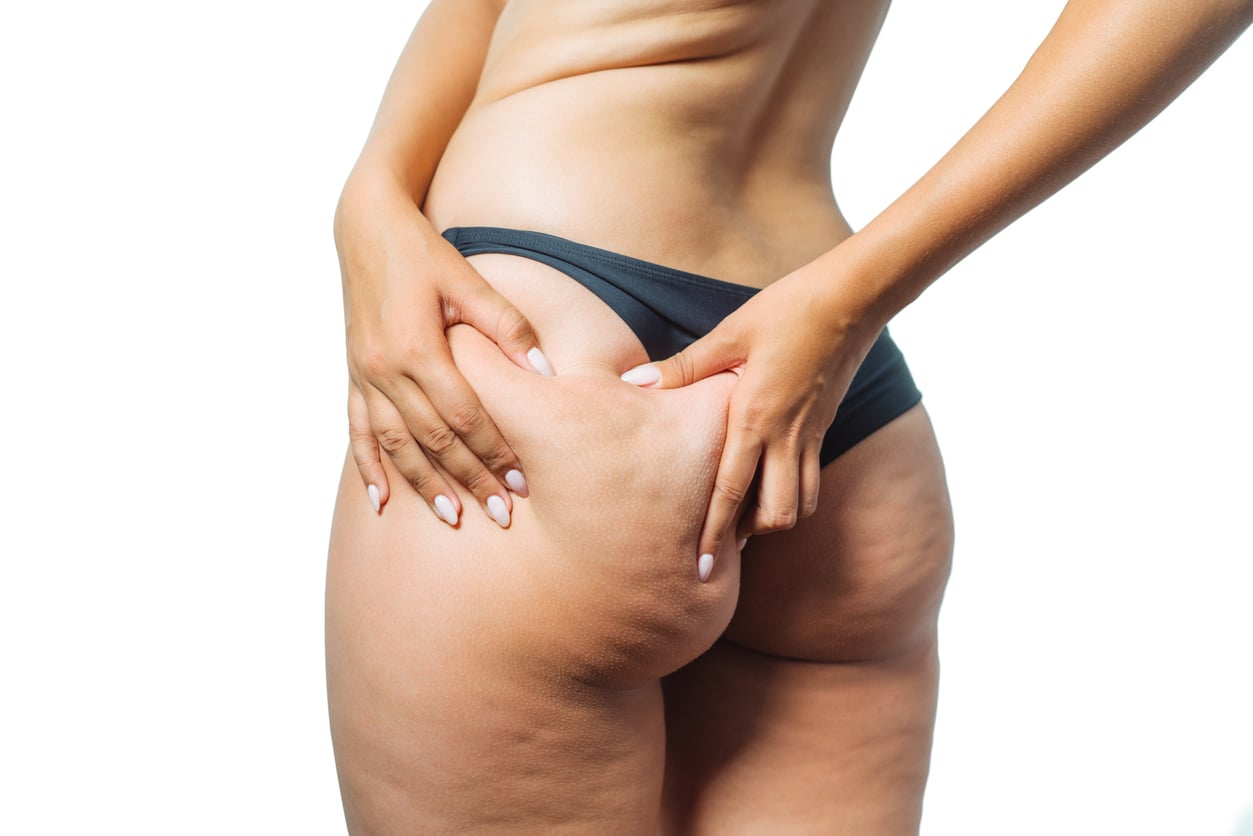 Women shows holding and pushing the skin of the legs cellulite, orange peel. Treatment and disposal of excess weight, the deposition of subcutaneous fat tissue