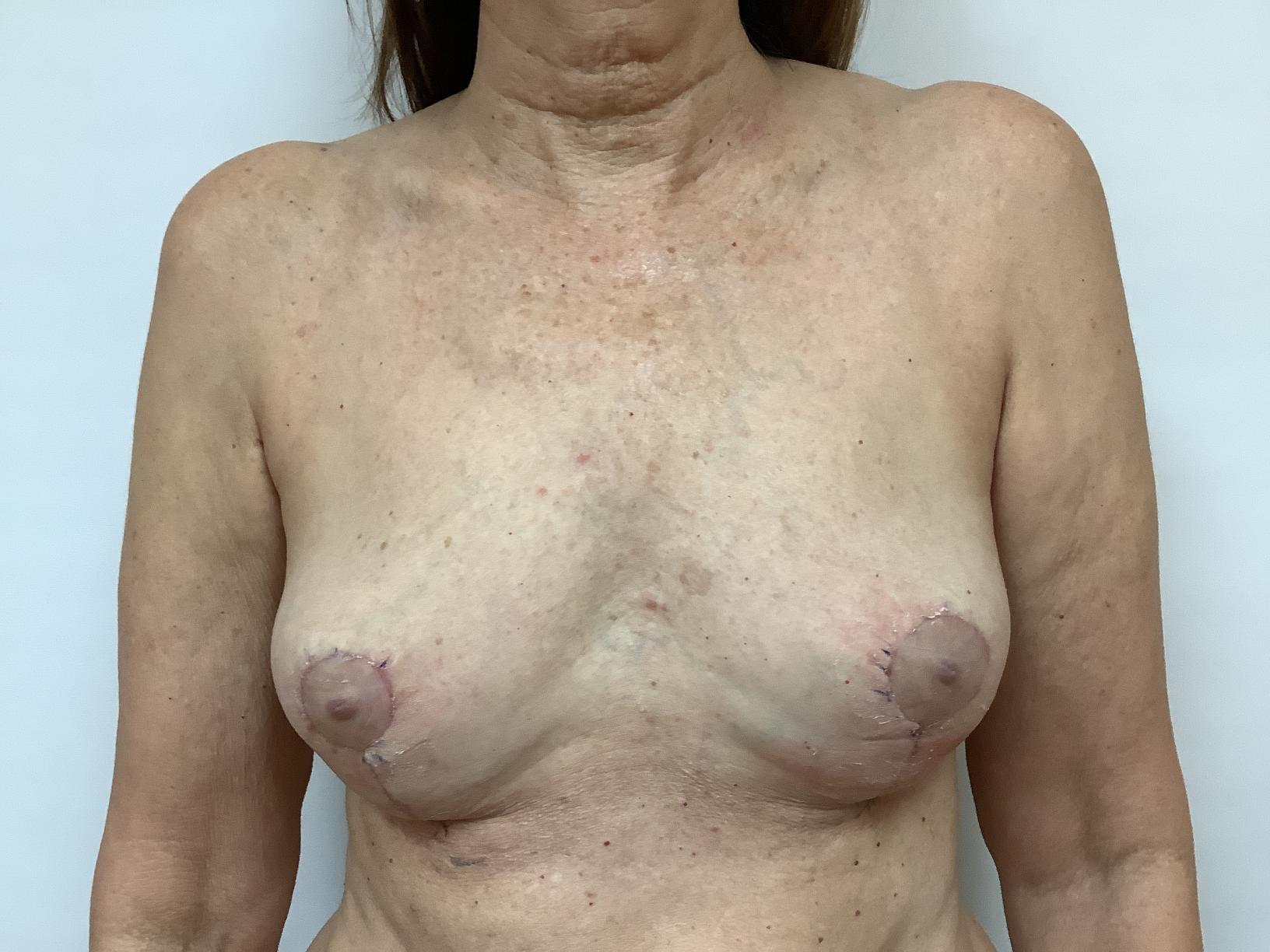 After Bilateral Implant Removal (Explant)+ Lejour Mastopexy