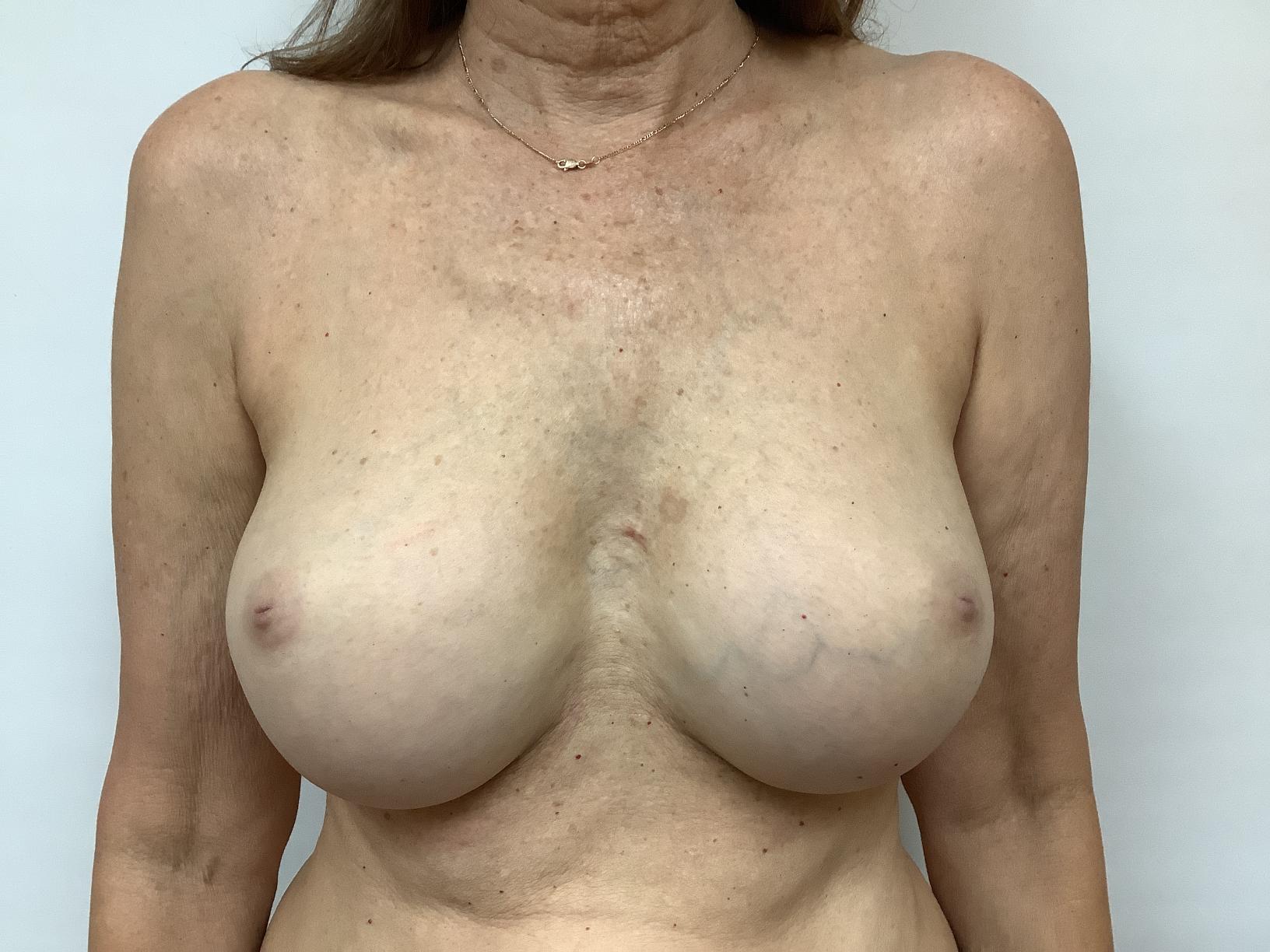 Before Bilateral Implant Removal (Explant)+ Lejour Mastopexy